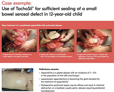 Use of TachoSil® for Sufficient Sealing of a Small Bowel Serosal Defect in 12-Year-Old Child