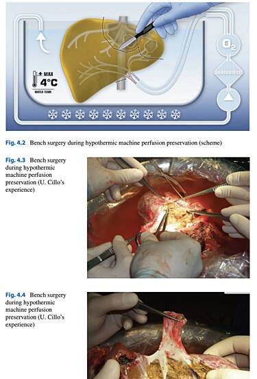 Hepatbiliary Surgery