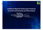 Unilateral Biportal Endoscopic Posterior Cervical Laminectomy and Discectomy
