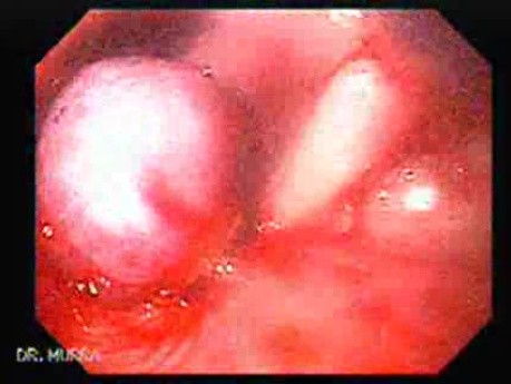 Esophageal Varix - Bleeding and Ligated Varix