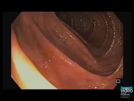 Normal Adult Colonic Anatomy in Colonoscopy