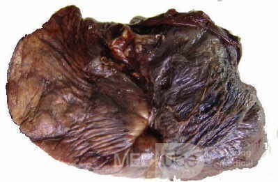 Lung Adenocarcinoma (5 of 5)