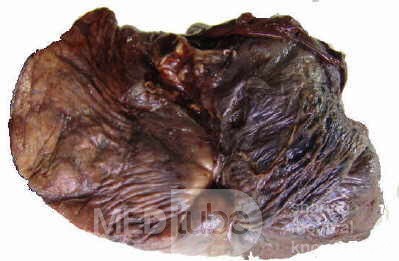 Lung Adenocarcinoma (5 of 5)