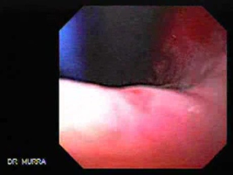 Esophageal Achalasia - Retroflexed View During Balloon Dilation