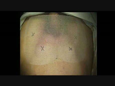 Laparoscopic Groin Hernia Repair, Step 7: Mesh Tailoring