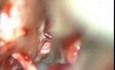 Epidermoid Cerebello Pontine Angle - Microsurgical Removal
