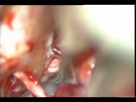 Epidermoid Cerebello Pontine Angle - Microsurgical Removal