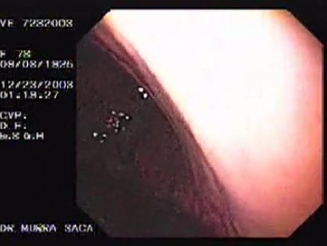 Hemorrhage due status post rubber band ligation of esophageal varices (19 of 25)