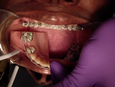 How To Apply Powerchain Correctly To Prevent Accidentally Rotating Teeth!