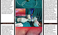 Video Assisted Thoracoscopic Talc Pleurodesis