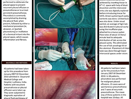 Video Assisted Thoracoscopic Talc Pleurodesis