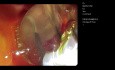 ERCP for Large CBD Stones