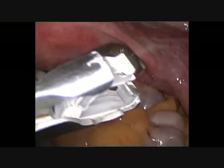 Laparoscopic Tubal Ligation with Filshie Clips