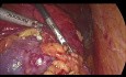Laparoscopic Partial Nephrectomy, Upper Pole Neoplasm