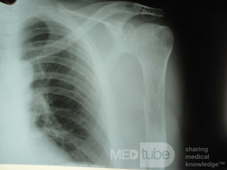 Colon Angiodysplasia and Multiple Myeloma (19 of 24)