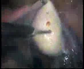 Laparoscopic Ovarian Drilling