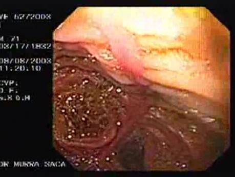 Esophago-Jejunostomy Roux-en-Y (4 of 6)