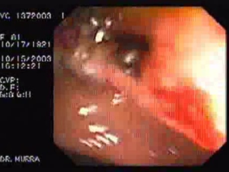 Tubulo - Villous Adenoma - Endoscopy (28 of 28)