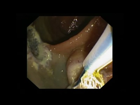 Papillectomy in a Patient with FAP