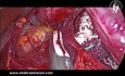 One Centimeter More: The Role of Vagal-Esophageal Adhesion Release to Achieve Additional Distal Esophageal Length