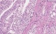 Prostate - Adenocarcinoma (Gleason grade 4) - Histopathology