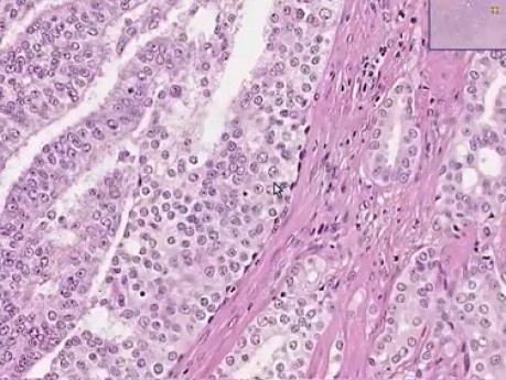 Prostate - Adenocarcinoma (Gleason grade 4) - Histopathology