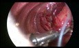 Thoracoscopic Repair of Congenital Diaphragmatic Hernia in Neonate