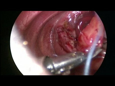Thoracoscopic Repair of Congenital Diaphragmatic Hernia in Neonate