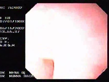 Tubulovillous Tumor (2 of 2)