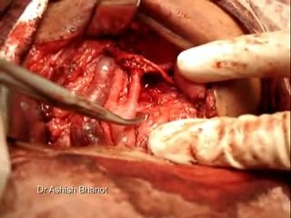 Cystic Hygroma