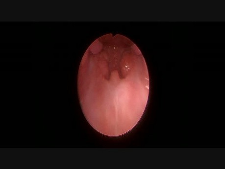 Endoscopic View of Phrynx During Tonsillectomy with Boyle Davis Gag Set In Place