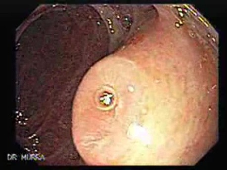 Adenocarcinoma of the cardias (4 of 14)