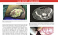 Case Report of Acute Appendicitis Complicated by a Cutaneous Fistula
