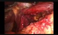 Laparoscopic Nissen Fundoplication