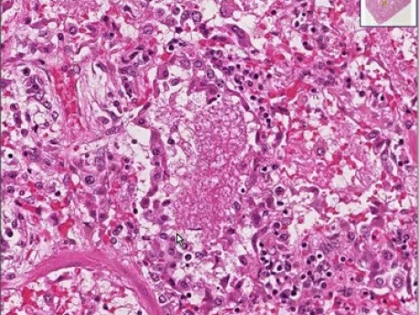 Pneumocystis pneumonia