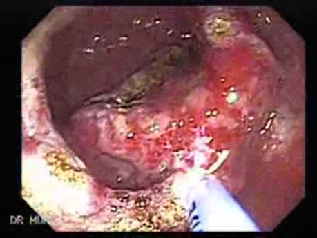 Multiple Adenomatous Polyps Of The Rectum (11 of 37)