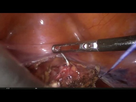 Sacrocolpopexy  for Fatty Patient