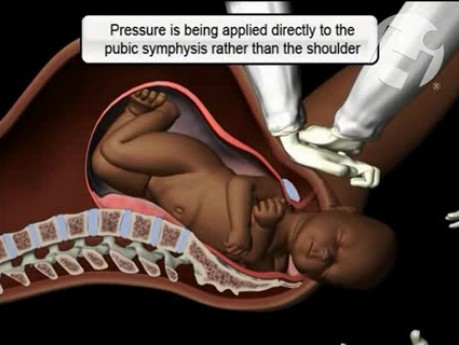 Shoulder Dystocia