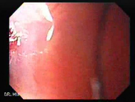 Endoscopic Assessment of Esophageal Papilloma, Part 2