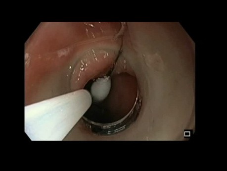 Gastric Pin Removal