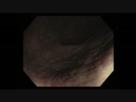 Colonoscopy - Melanosis masquerading as cancer