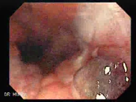 Endoscopy of Mallory Weiss Syndrome - Linear Tear
