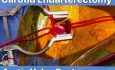 AVR + Right Carotid Endarterectomy