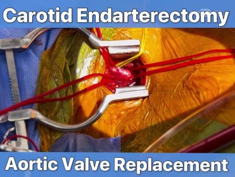 AVR + Right Carotid Endarterectomy