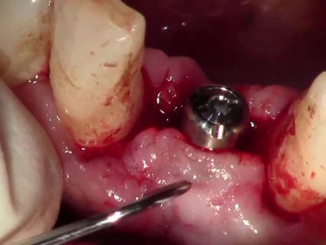 Paracrestal Incision - Uncovery Of Lower Anterior Implant