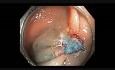 Colonoscopy Channel: Subtle Flat Lesion In Ascending Colon