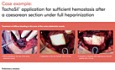 TachoSil® Application for Sufficient Haemostasis After a Caesarean Section Under Full Heparinization