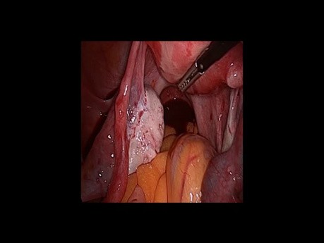 Incidental Tubal Ectopic Pregnancy - Laparoscopy