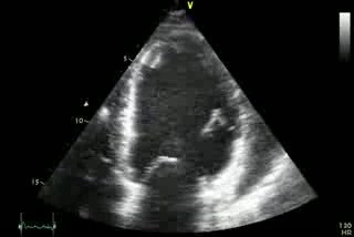 Ischemic Cardiomiopathy