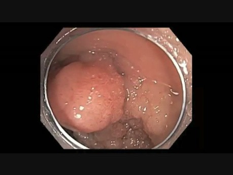 A LST G Lesion 